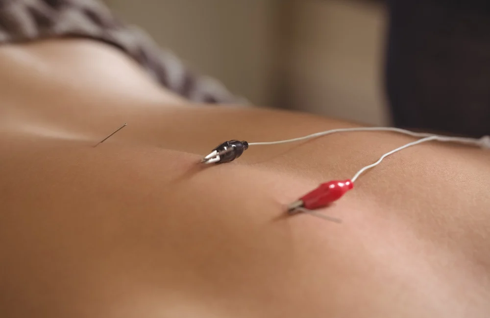 Acupuncture, Acupuncture treatment